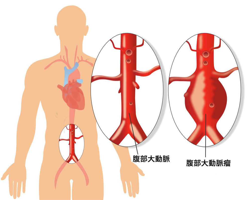 腹部大動脈瘤