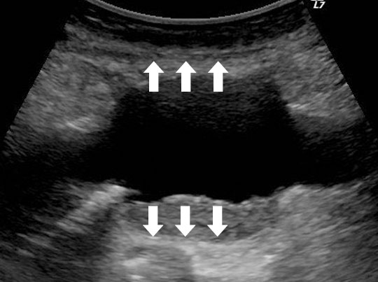 腹部⼤動脈瘤のエコー画像
