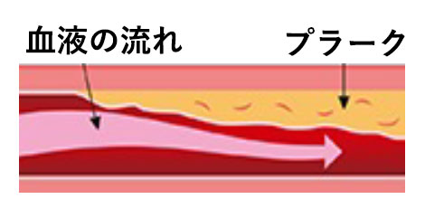 閉塞性動脈硬化症の模式図