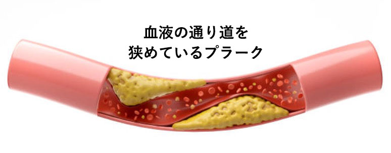 動脈硬化（血液の通り道を狭めているプラーク）