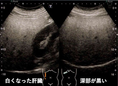 従来の肝脂肪化評価のエコー画像