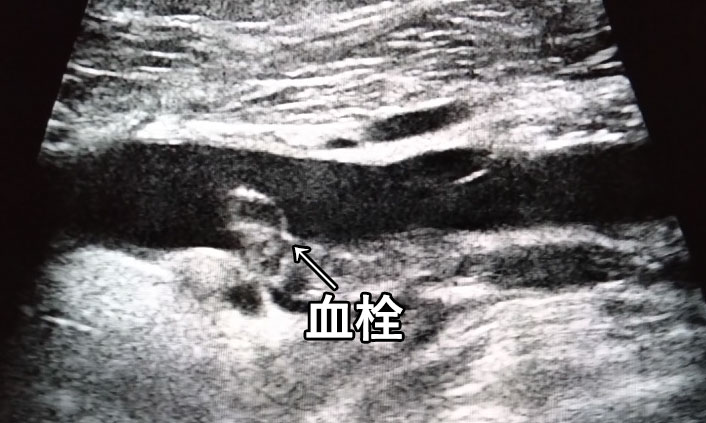 深部静脈⾎栓症の静脈のエコー画像