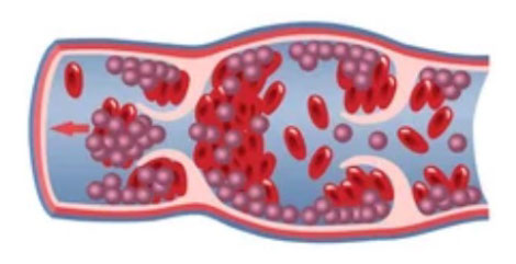深部静脈⾎栓症の静脈の模式図
