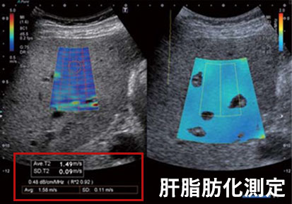 肝脂肪化測定のエコー画像