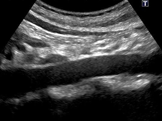 正常な腹部⼤動脈のエコー画像