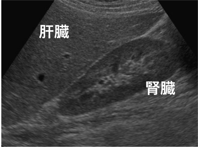正常な肝臓のエコー画像
