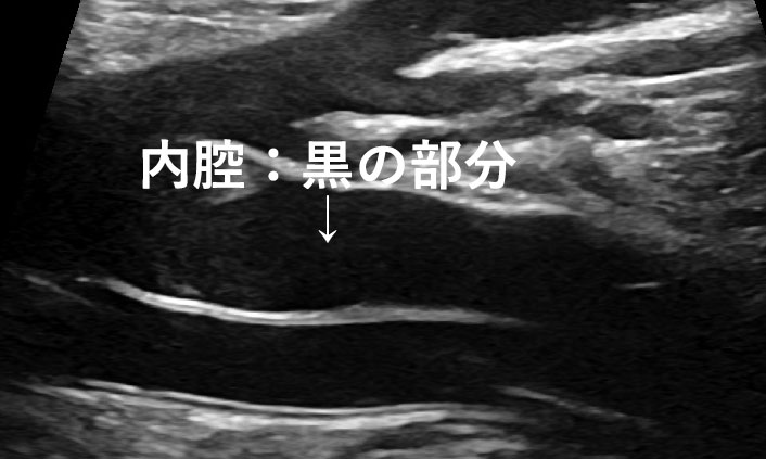 正常な下肢静脈のエコー画像