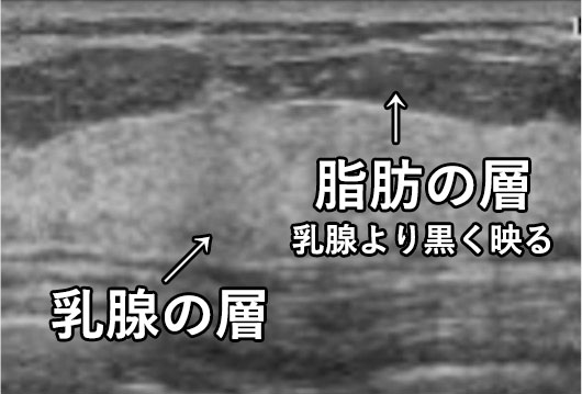 正常な乳腺の画像