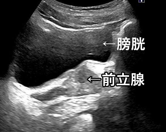 正常な前立腺のエコー画像