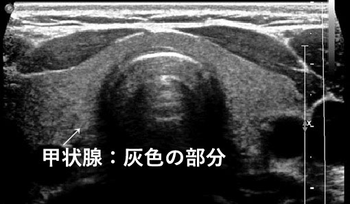 正常な甲状腺のエコー画像