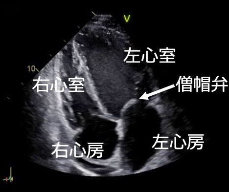 正常な心臓のエコー画像