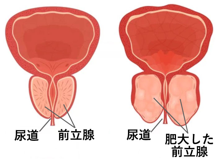 正常な前立腺と肥大した前立腺