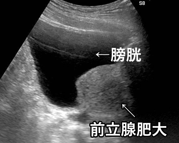 前立腺肥大のエコー画像