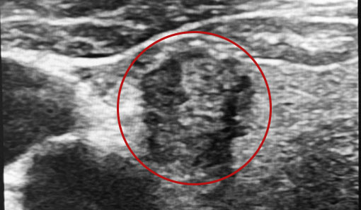 甲状腺がんのエコー画像