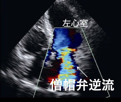 心臓弁膜症（僧帽弁逆流）のエコー画像